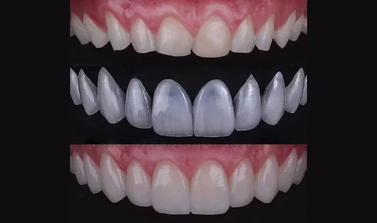 Veneers before and after