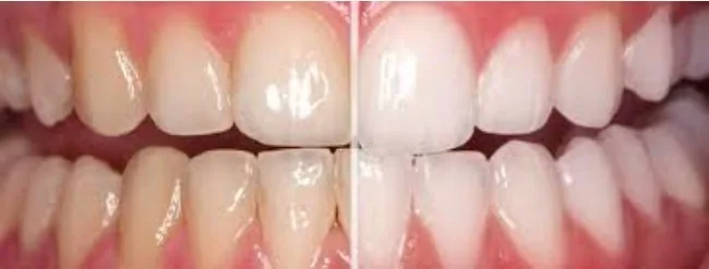 Whitening before and after