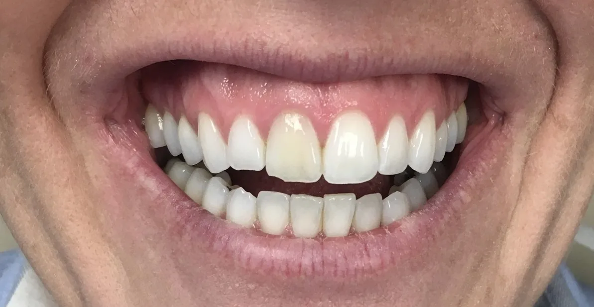 Before internal bleaching