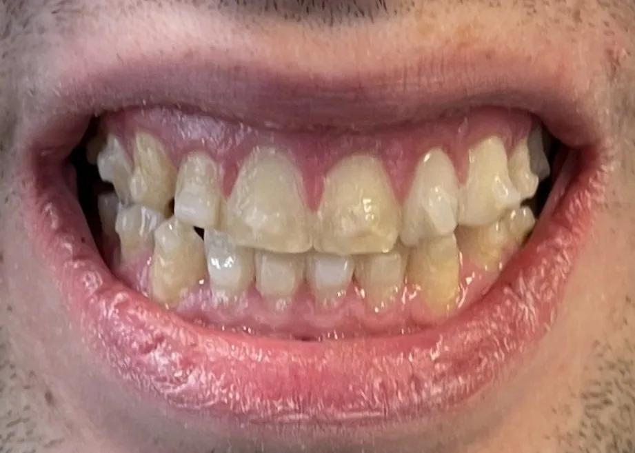 Before
